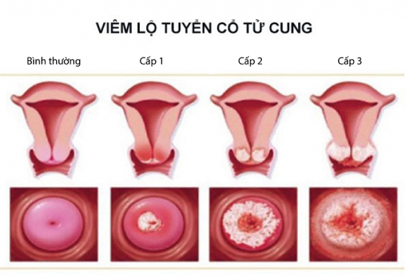Hình ảnh viêm lộ tuyến cổ tử cung qua 3 cấp độ